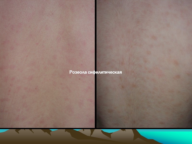 Розеола сифилитическая Розеола сифилитическая